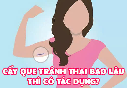 Cấy que tránh thai bao lâu thì có tác dụng