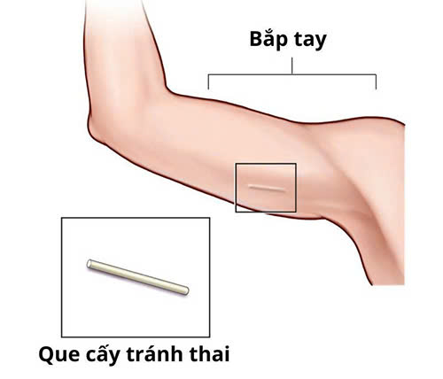 Nữ giới Cấy que tránh thai bao lâu thì có tác dụng